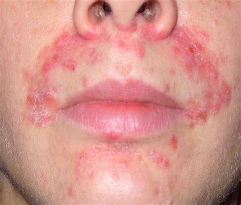 Perioral Dermatitis Symptom