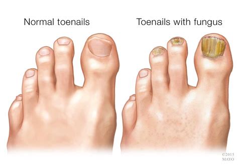 A seemingly harmless fashion trend can put you at risk of toenail fungus in Los Angeles ...