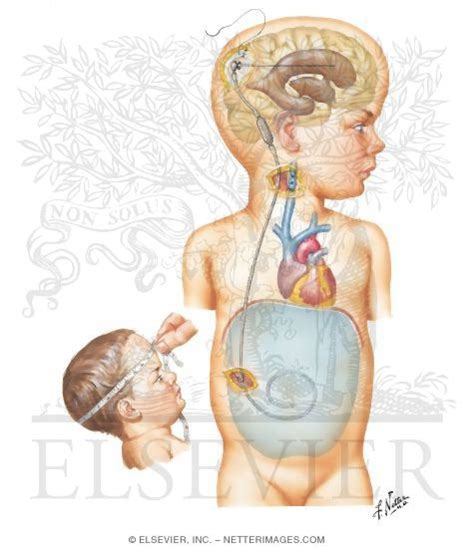 Shunt Procedure for Hydrocephalus