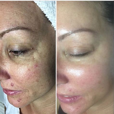 adapalene acne scars before after - Vanessa Anderson