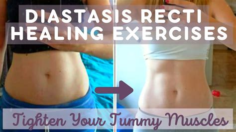 Diastasis Recti Healing Exercises Part 1 (TIGHTEN TUMMY MUSCLES AFTER ...