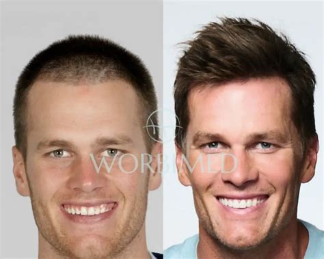 Tom Brady Hair Transplant l Before and After