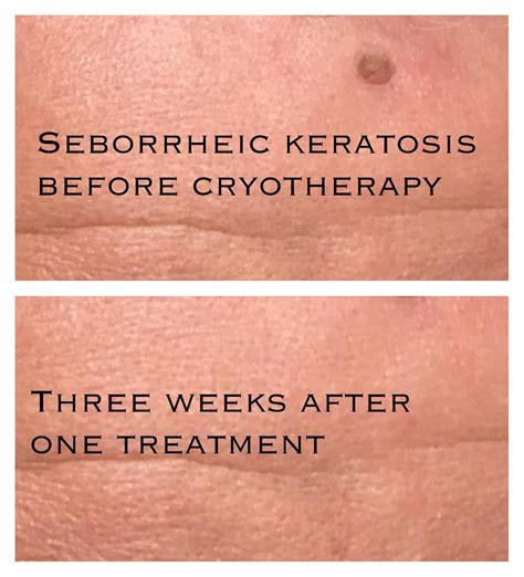 Seborrheic Keratosis Face Removal