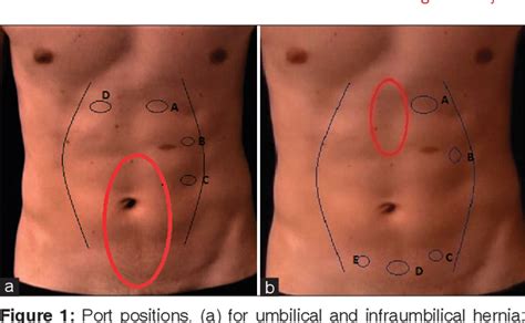 Figure 1 from Extended totally extraperitoneal repair (eTEP) for ...