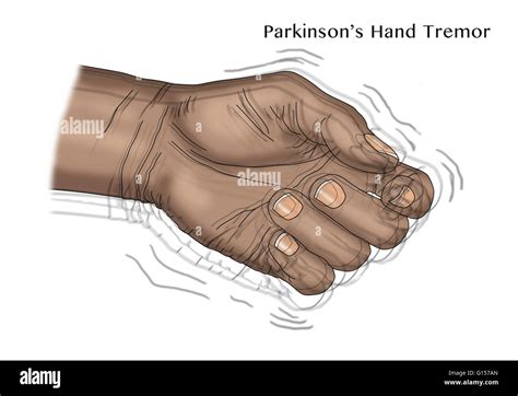 Illustration of a hand tremor, one of the symptoms of Parkinson's ...