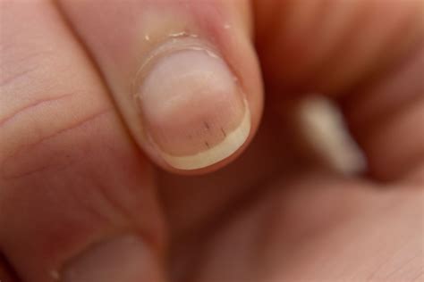 Nail Changes in Kidney Disease: Symptoms, Causes, and Remedies - World Today News