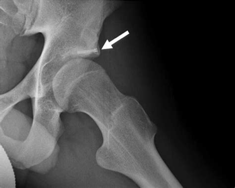 Screw Fixation of Os Acetabuli: An Arthroscopic Technique - Arthroscopy ...