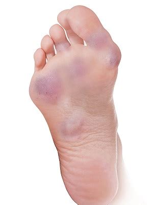 Foot Rheumatoid Arthritis Sugar Land | Foot Dislocation | Inflammatory Disease Sugar Land