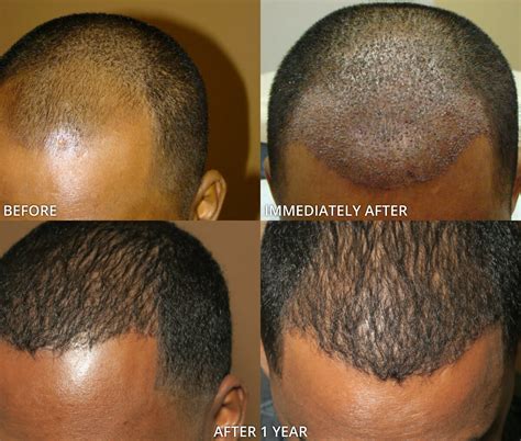 3500 Grafts Hair Transplant Before And After - Before And After Graft ...