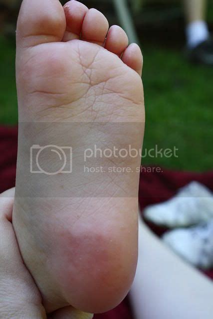 Plantar warts? Not gross pics included* - BabyCenter