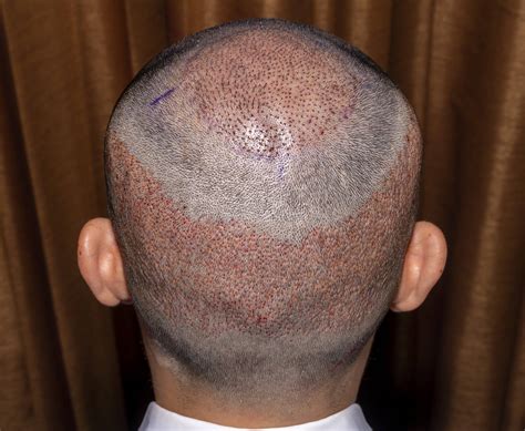 FUE Hair Transplant - Elit International Clinic