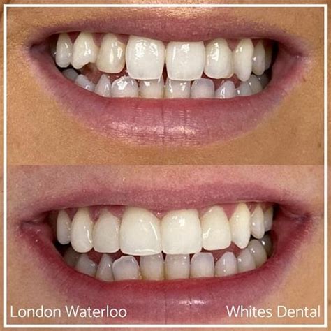 Composite Bonding Before And After Photos | Whites Dental