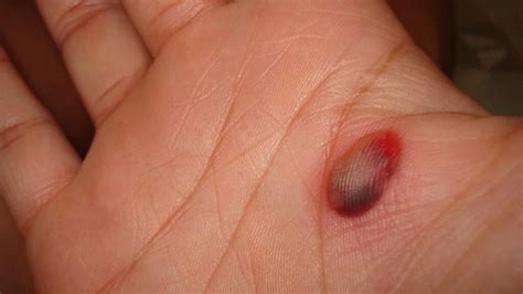 Blood Blisters: Symptoms, Causes, and Treatment