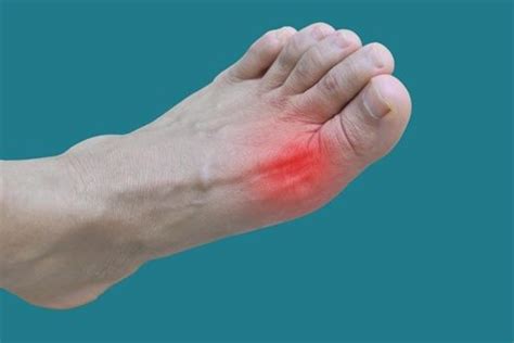 Joint Pain And Swelling? Common Signs Of Gout - Woodside Clinic