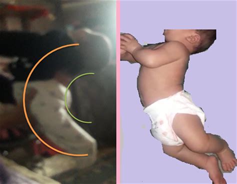 Sandifer’s Syndrome in a 3-Month-Old Male Infant: A Case Report