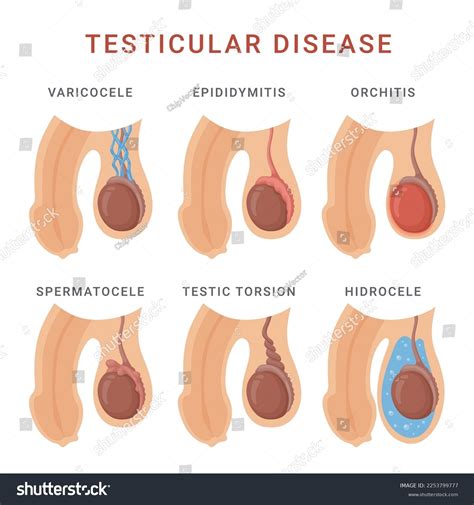 Epididymitis Symptoms In Women