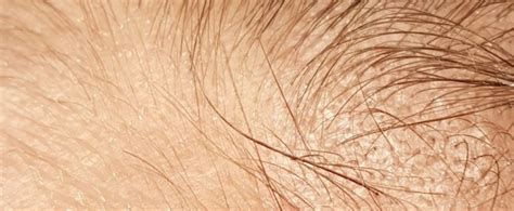 Vellus Hair, Normal or Abnormal?