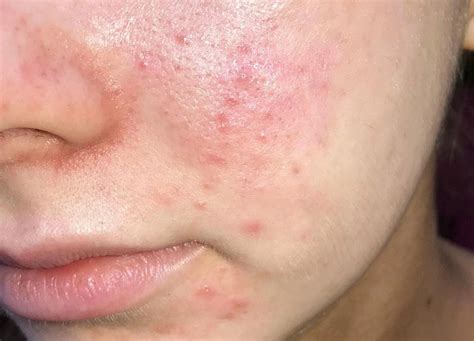 An Overview of Fungal Acne: Causes, Symptoms, and More | by ...