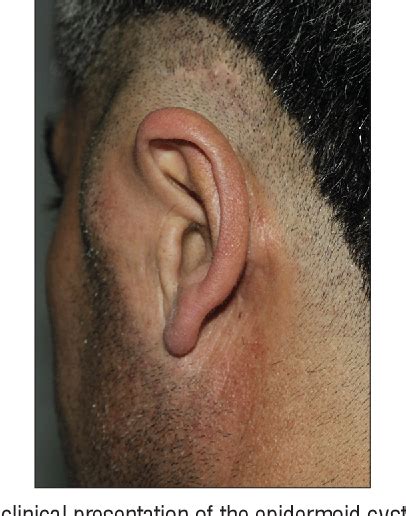 Figure 1 from Preauricular iatrogenic epidermoid cyst through middle-ear surgery | Semantic Scholar