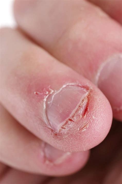 Nail abnormalities: Causes, symptoms, and pictures