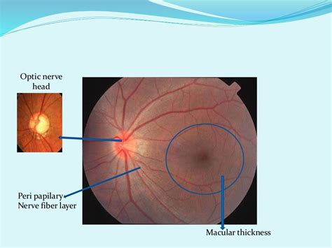 Oct in glaucoma