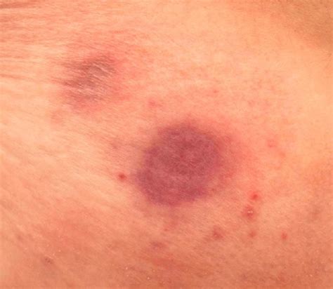 leukemia cutis erythroderma Lymphoma action