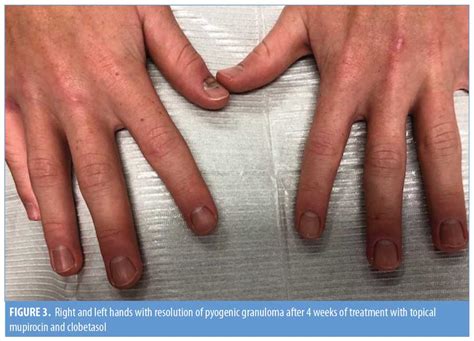 Development of Periungual Pyogenic Granuloma with Associated Paronychia Following Isotretinoin ...