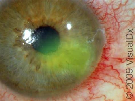 Recurrent Corneal Erosion: Causes, Symptoms, and Treatment