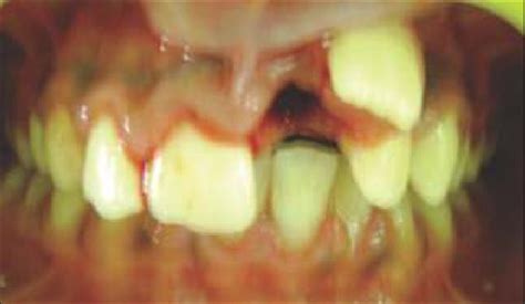 The supplemental mesiodens was extracted | Download Scientific Diagram