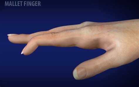 What Is A Mallet Finger? - Virtual Hand Care