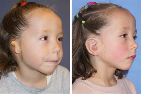 Microtia Treatment Beverly Hills, CA - Reinisch Plastic Surgery