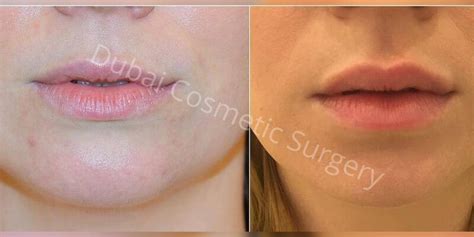 Voluma Filler For Men & Women in Dubai and Abu Dhabi | Dubai Cosmetic Surgery®