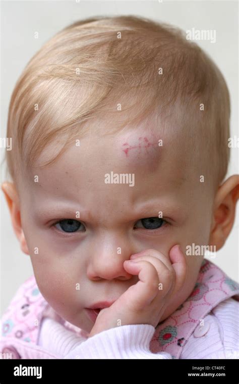 CHILD WITH HEMATOMA Stock Photo - Alamy