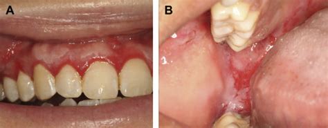 Mucocutaneous Diseases | Pocket Dentistry