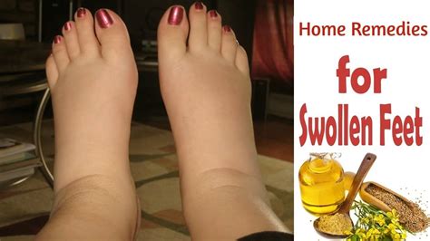 6 Natural Soothing Home Remedies For Swollen Feet And Ankles - YouTube