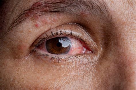 Long Term Antiviral Use is Key to Ocular Shingles Treatment - Penn Medicine