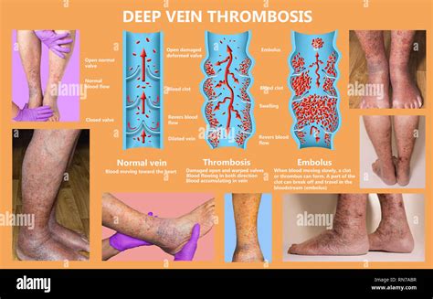 Syndrome mécanisme, thrombose veineuse profonde ou d'une thrombose veineuse profonde, embolie ...