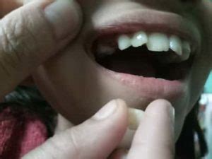 Molar Teeth Removal - What You Should Know