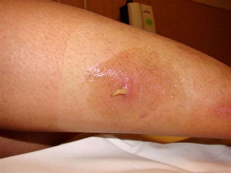 Furuncular Myiasis From Dermatobia Hominus: A Case of Human Botfly Infestation - Journal of ...