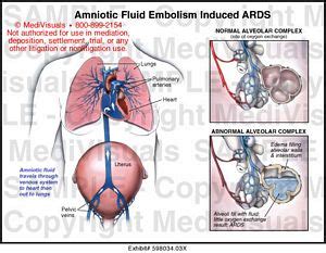 Amniotic Fluid Embolism Induced ARDS Medical Illustration