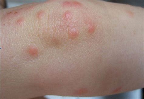 What Causes Small Red Itchy Bumps On Skin