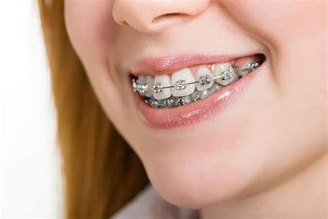 Gold Braces: The Ultimate Guide to what you need to know