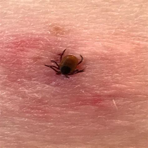 tick-on-skin - Pest Hacks