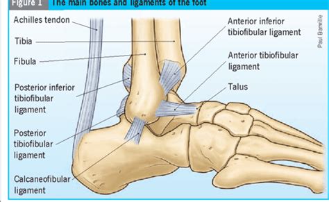 Figure 6 from Avulsion fracture of the calcaneal tuberosity: diagnosis and treatment. | Semantic ...