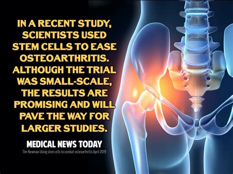 Stem Cell Therapy for Arthritis - Peter A. Fields, MD, DC