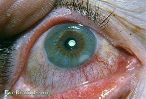 Staphylococcal Marginal Keratitis