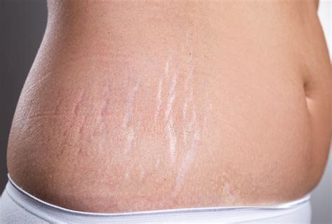 STRETCH MARKS – Dermatology Conditions and Treatments