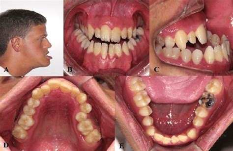 (A) Lateral view of patient #10 showing mandibular prognathism; (B)... | Download Scientific Diagram