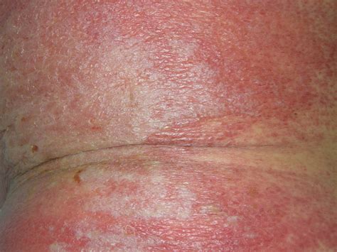 toxic erythema - pictures, photos