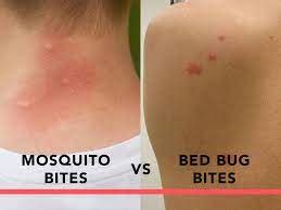 Mosquitoes Bites Vs Bed Bug Bites